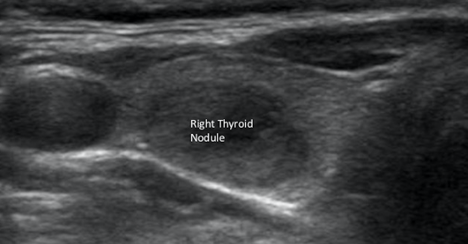 normal thyroid ultrasound