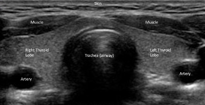 Normal Thyroid Ultrasound