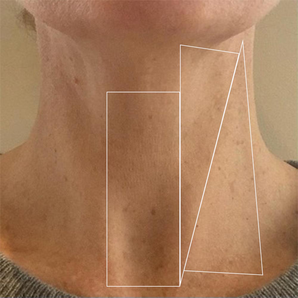 very swollen lymph nodes in neck